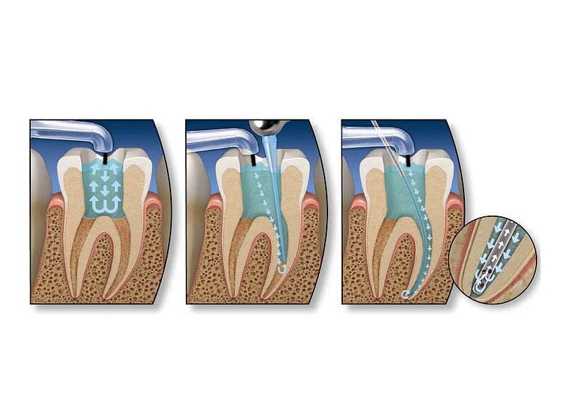 Kanal Tedavisi - Medikament Ağız ve Diş Sağlığı Polikliniği